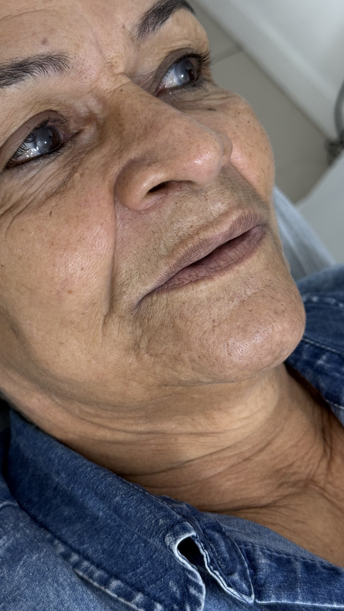 Antes do procedimento com fios PDO nos lábios. Paciente com flacidez labial, rugas periorais e ptose do contorno labial. Clínica Dr. Gustavo Martins, Rio de Janeiro.
