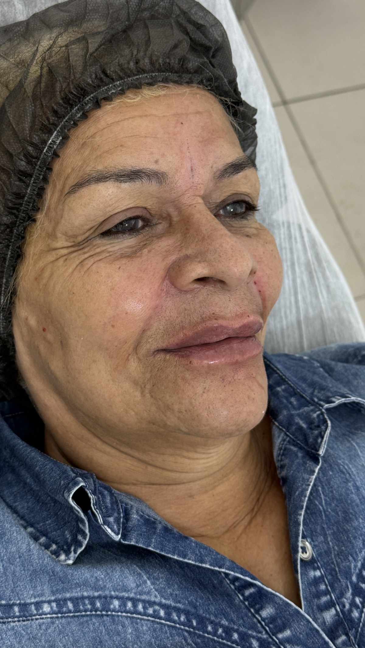 Resultado de fios PDO nos lábios para tratamento de flacidez labial na Clínica Dr. Gustavo Martins