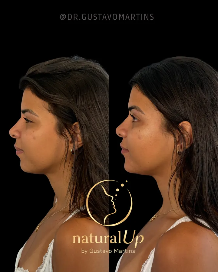 Método NaturalUp® — paciente 2