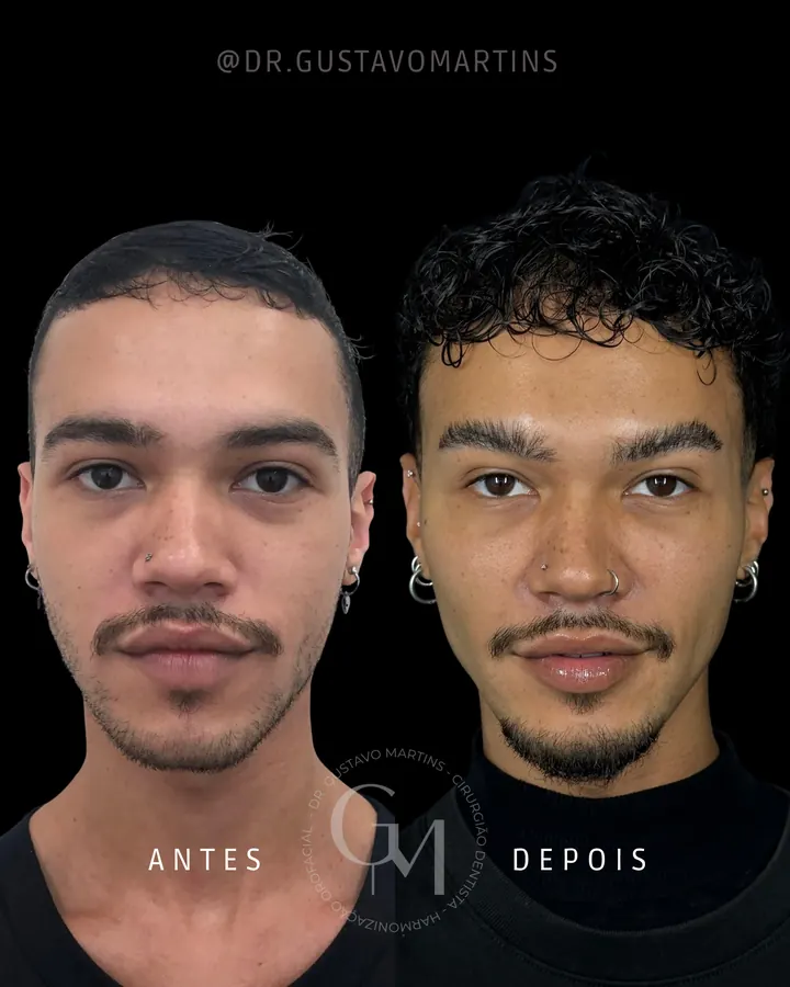 Método NaturalUp® — paciente 4