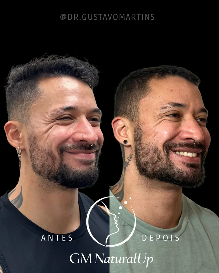 Método NaturalUp® — paciente 5