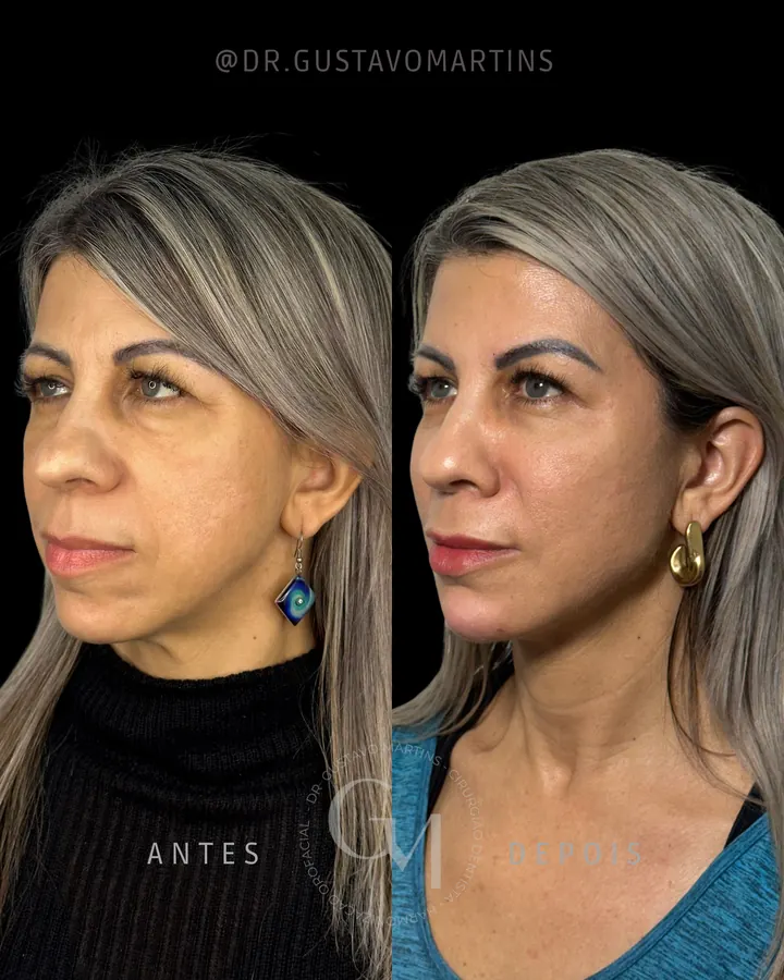 Método NaturalUp® — paciente 10