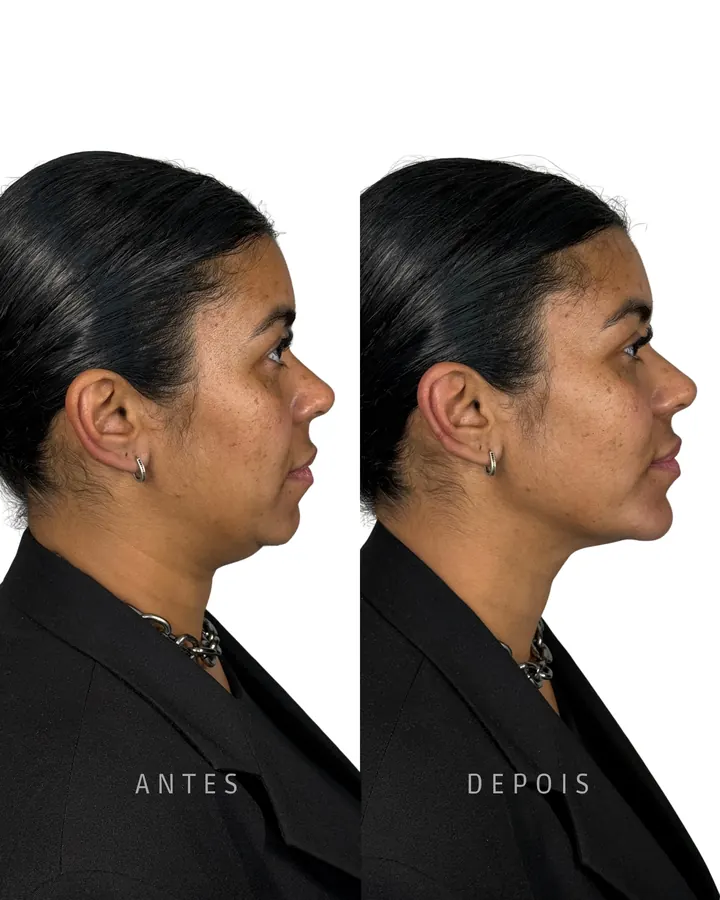 Método NaturalUp® — paciente 13