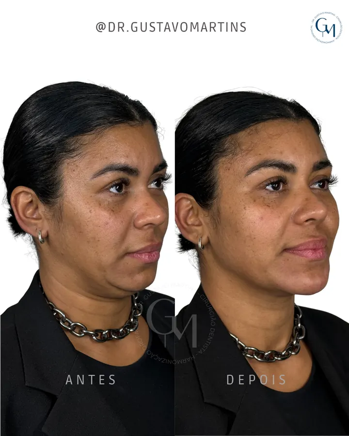 Método NaturalUp® — paciente 14