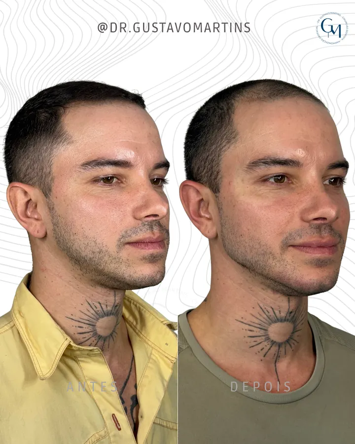 Método NaturalUp® — paciente 17