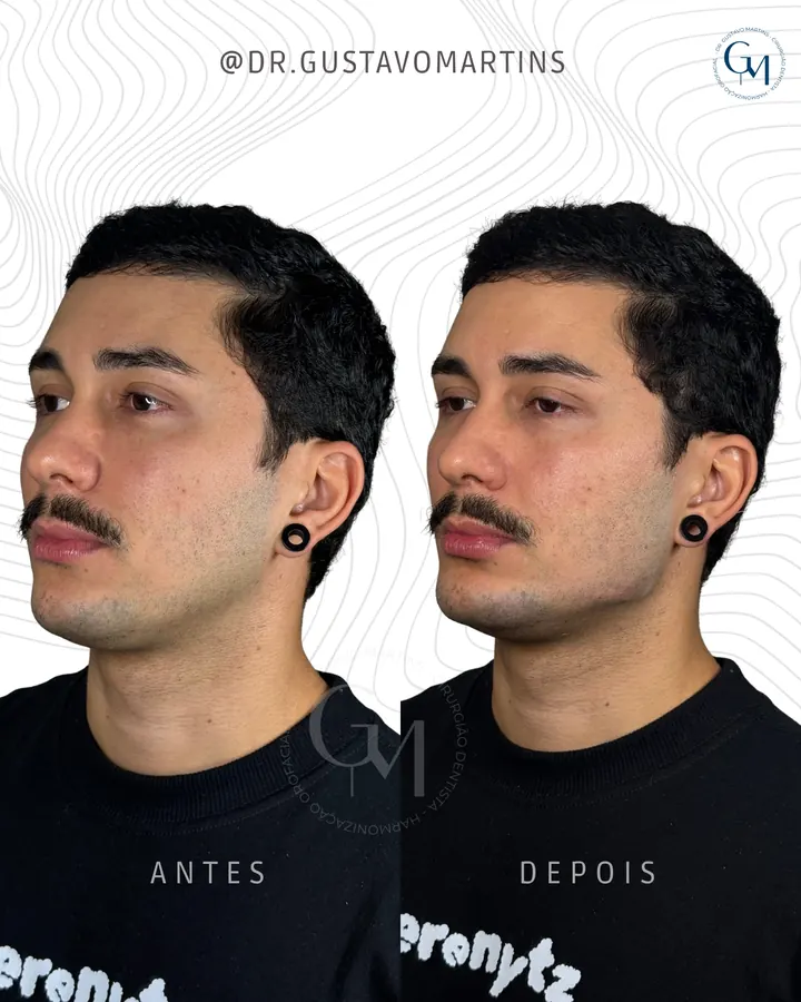 Método NaturalUp® — paciente 18