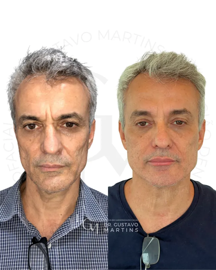 Método NaturalUp® — paciente 21