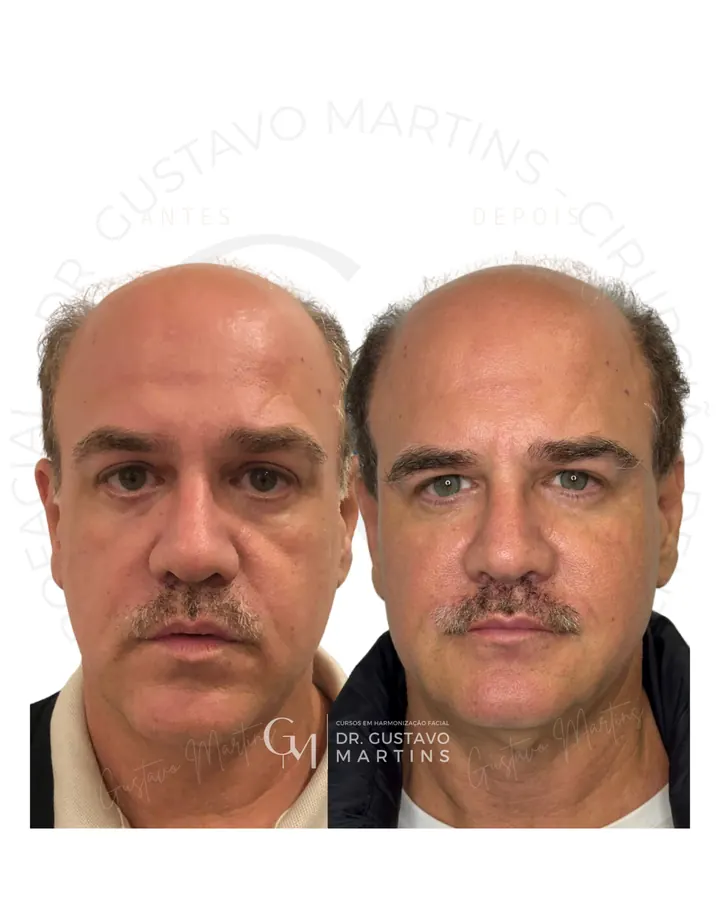 Método NaturalUp® — paciente 22