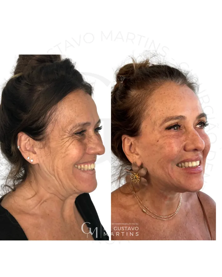 Método NaturalUp® — paciente 23