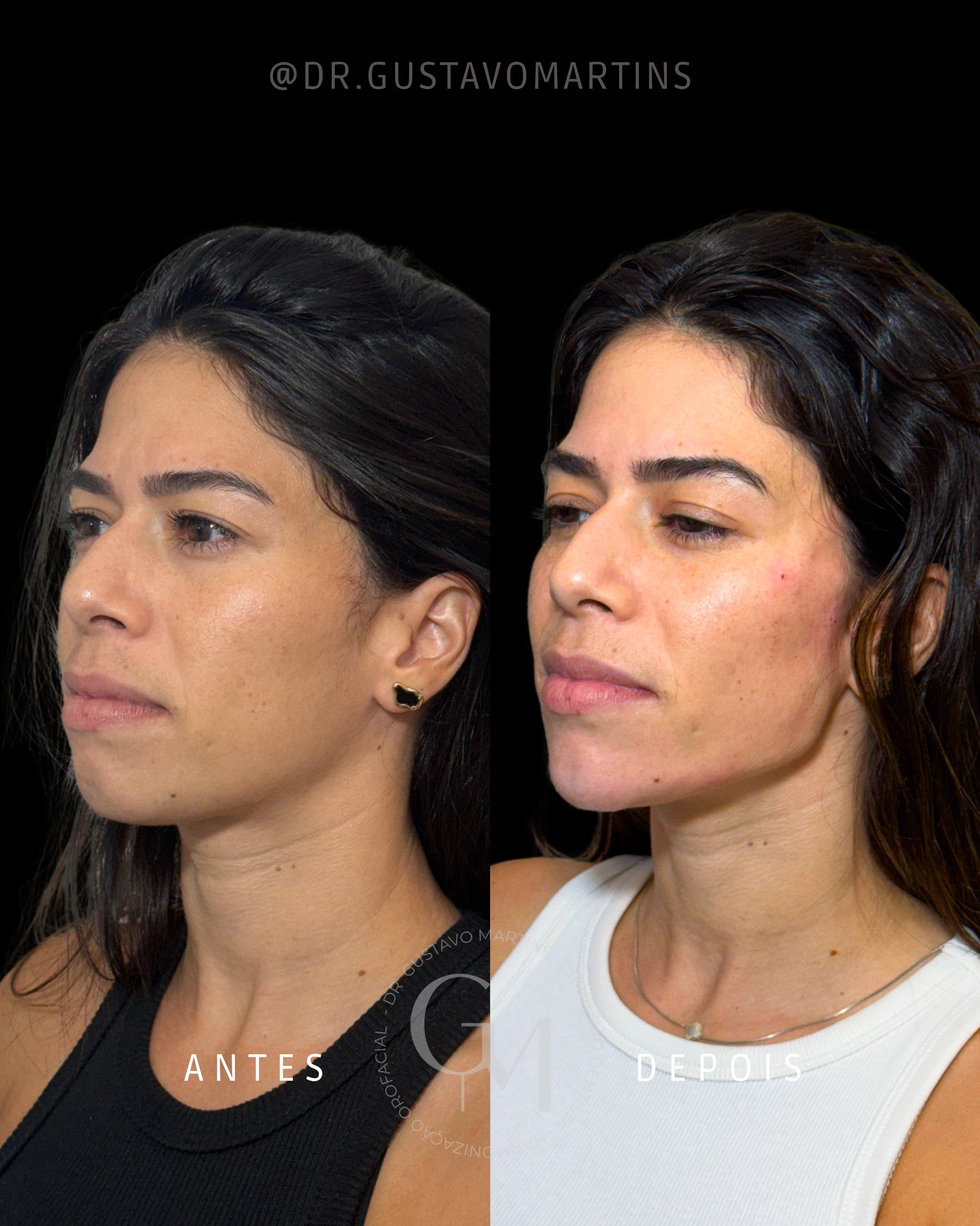 Harmonização Facial · paciente 27