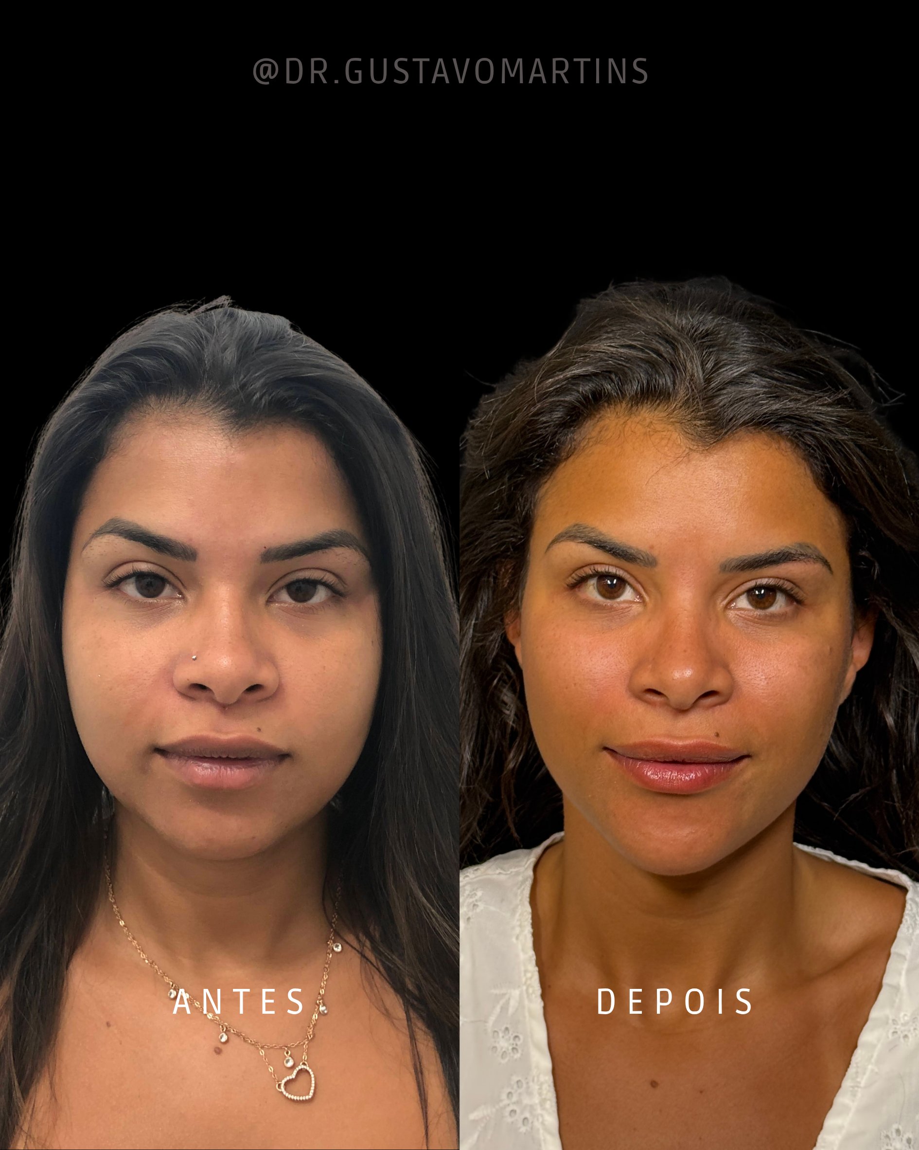 Harmonização Facial · paciente 28
