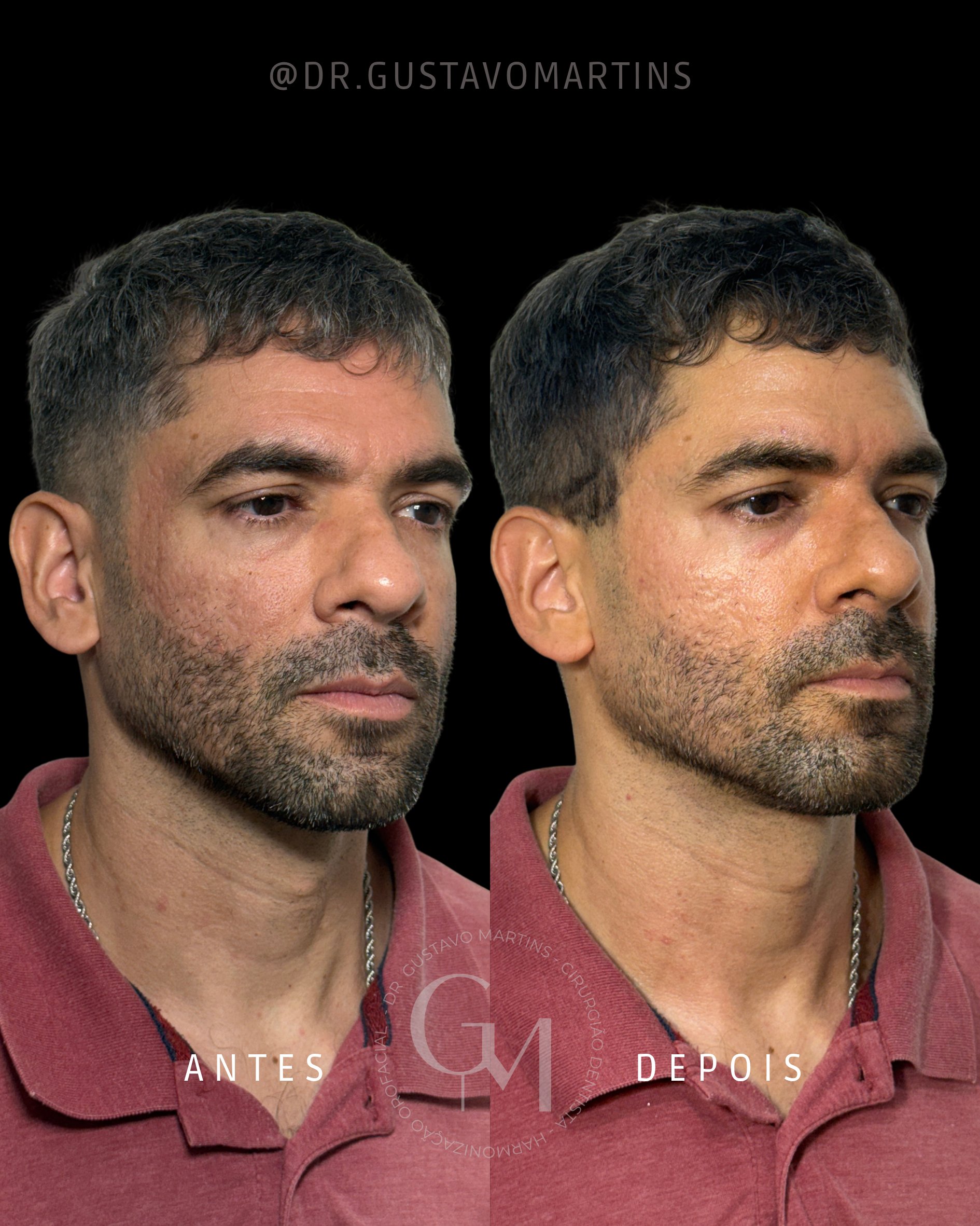 Tratamento de Pele · cicatrizes de acne