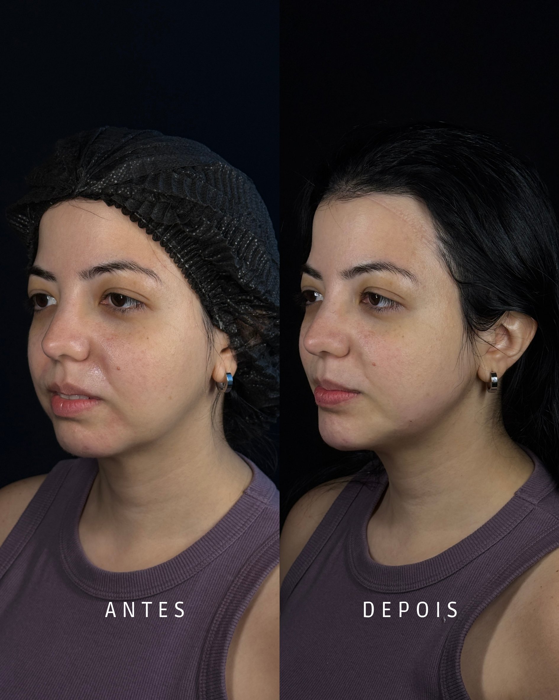 Harmonização Facial · paciente 32