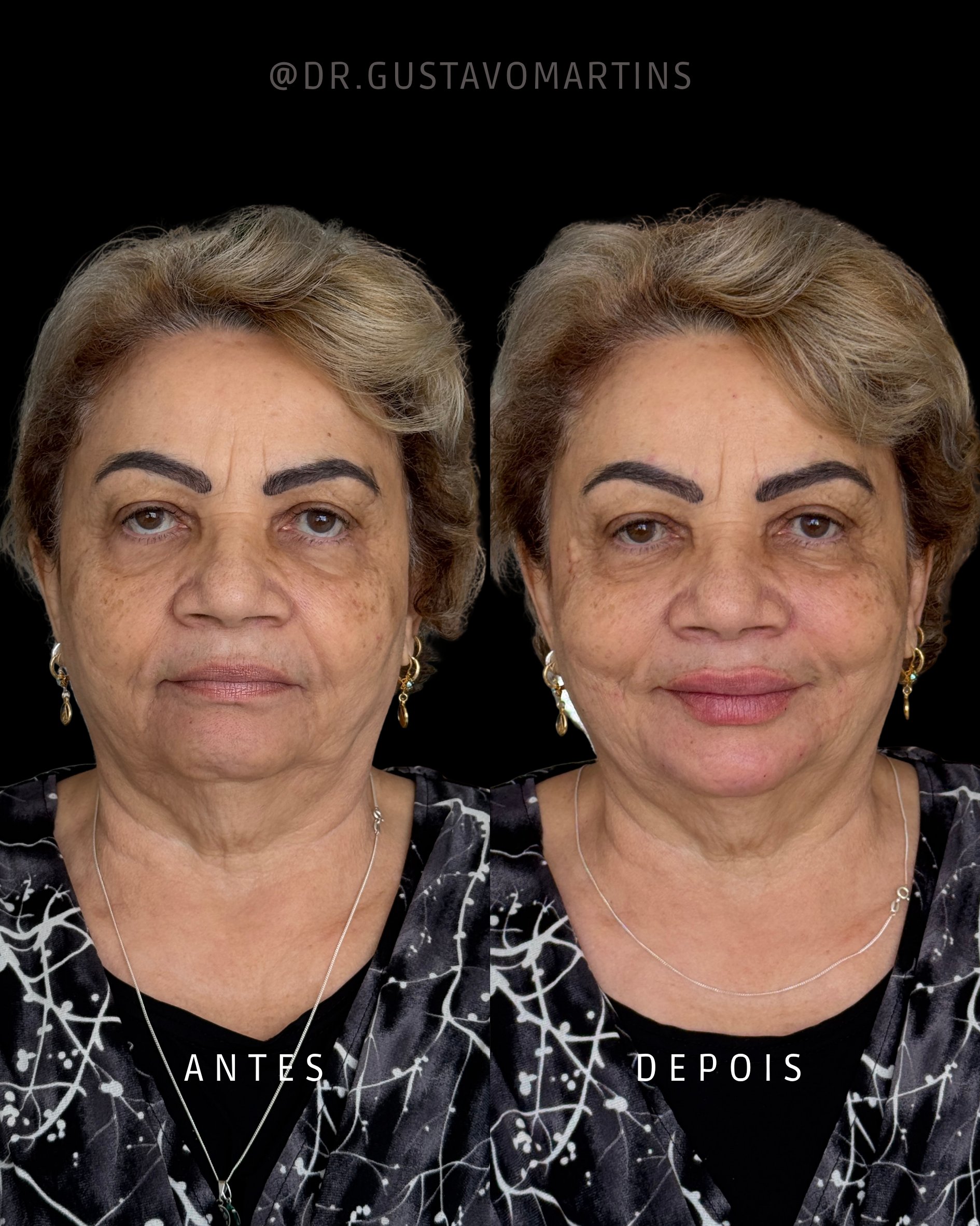 Harmonização Facial · paciente 34