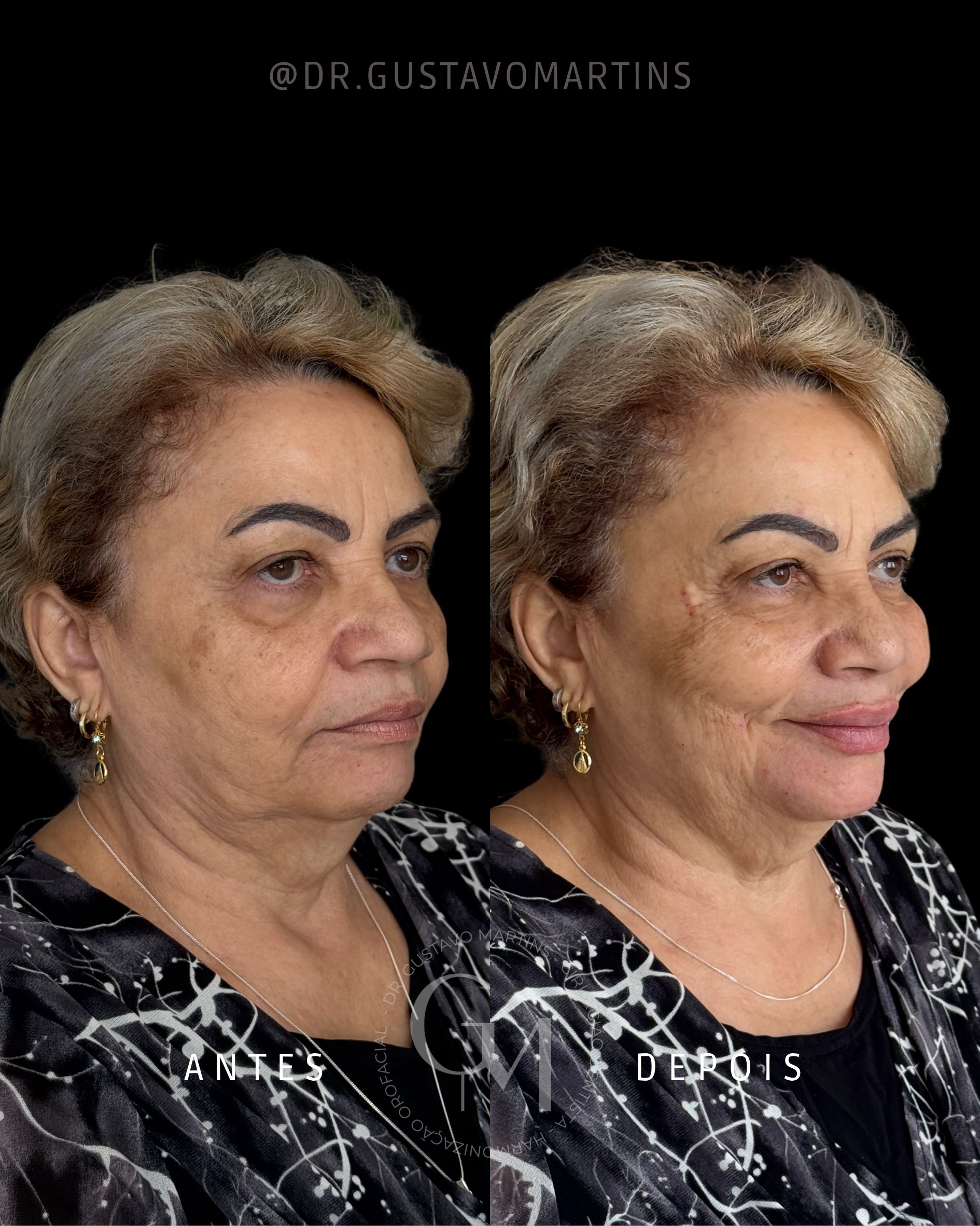Harmonização Facial · paciente 35