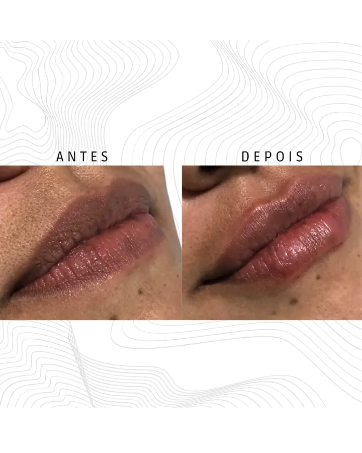 Preenchimento Labial — paciente 4