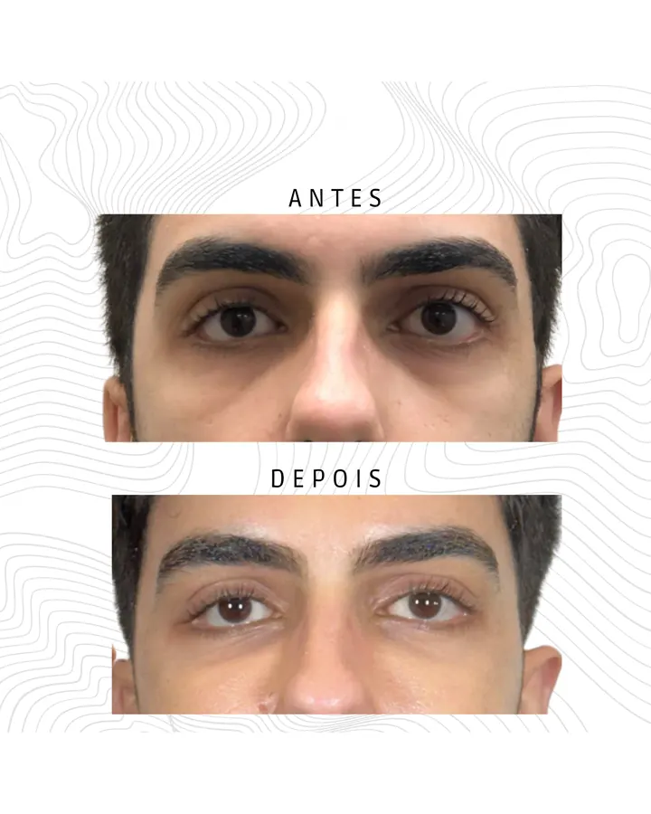 Tratamento de Olheiras — paciente 1