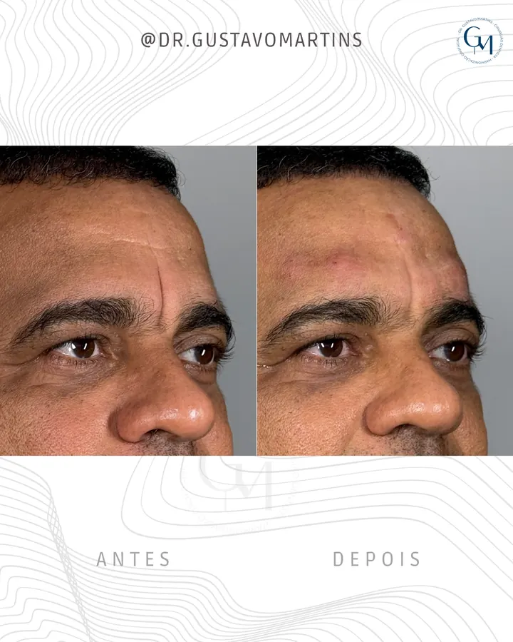 Tratamento de Olheiras — paciente 2