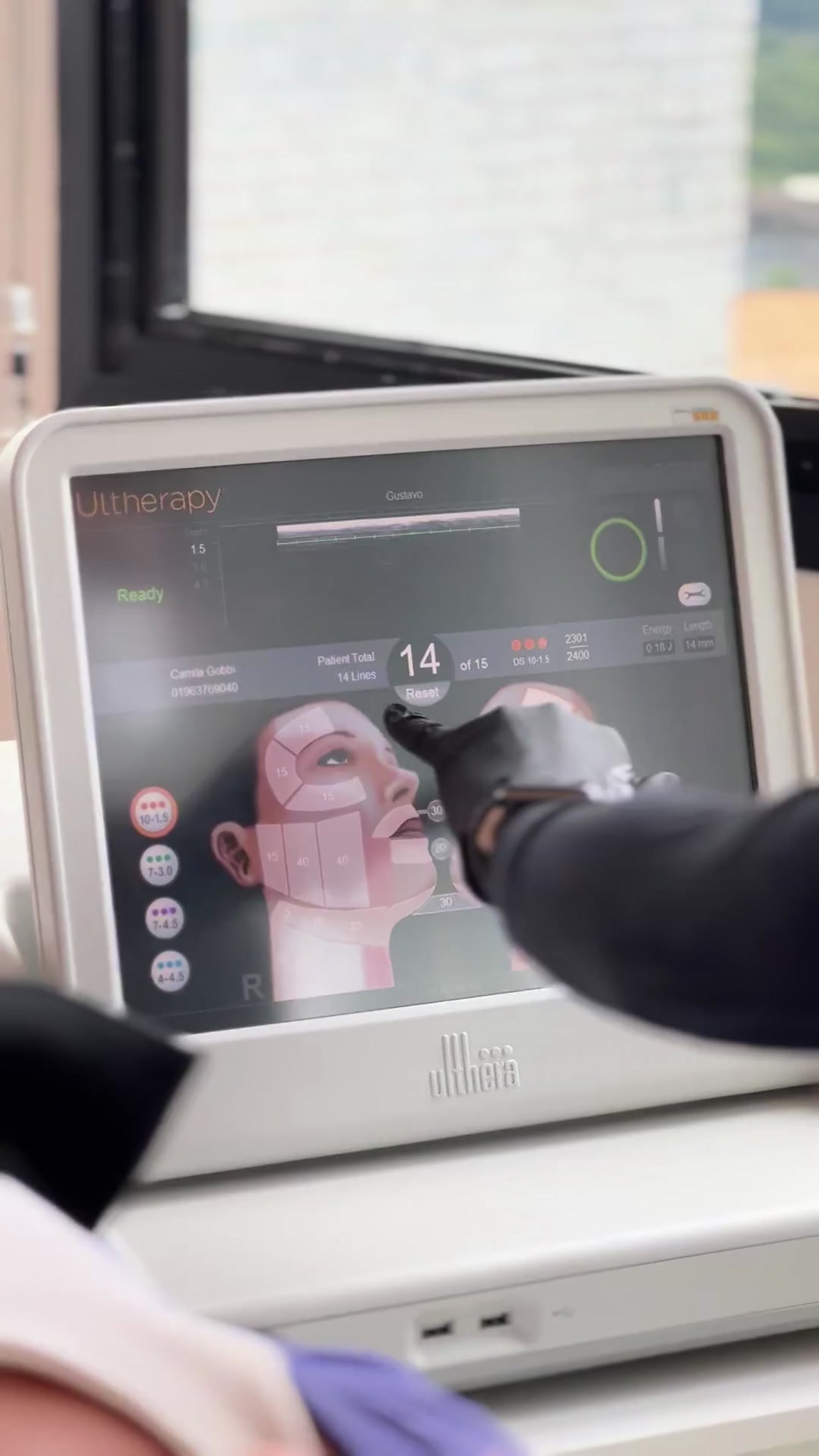 Tela do Ultherapy mostrando planejamento personalizado do tratamento em tempo real