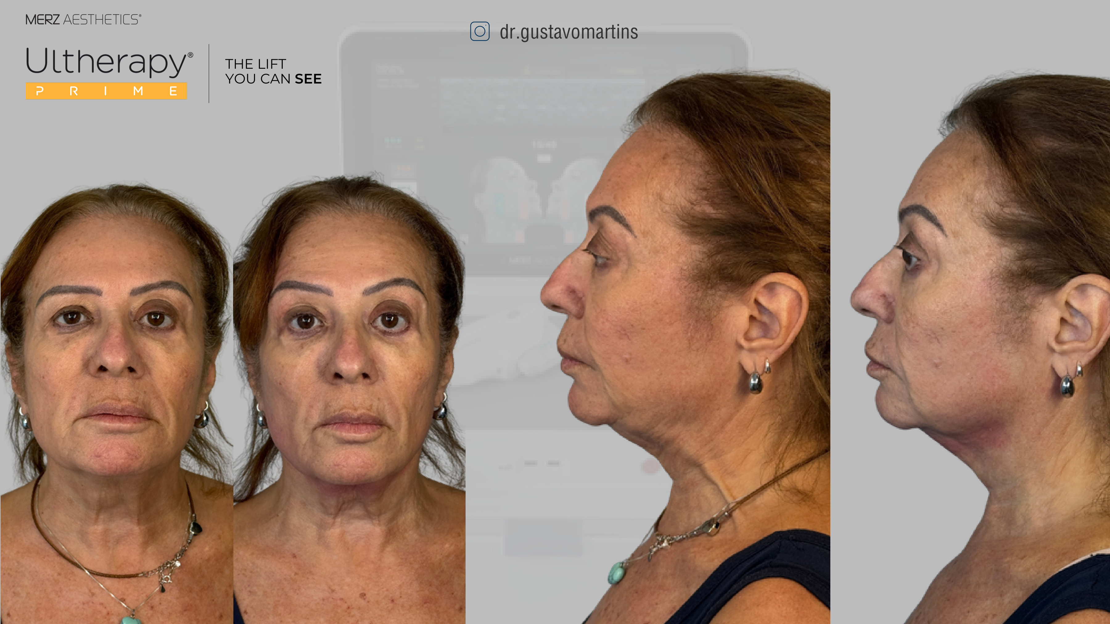 Antes e depois Ultherapy — frente e perfil — paciente real do Dr. Gustavo Martins