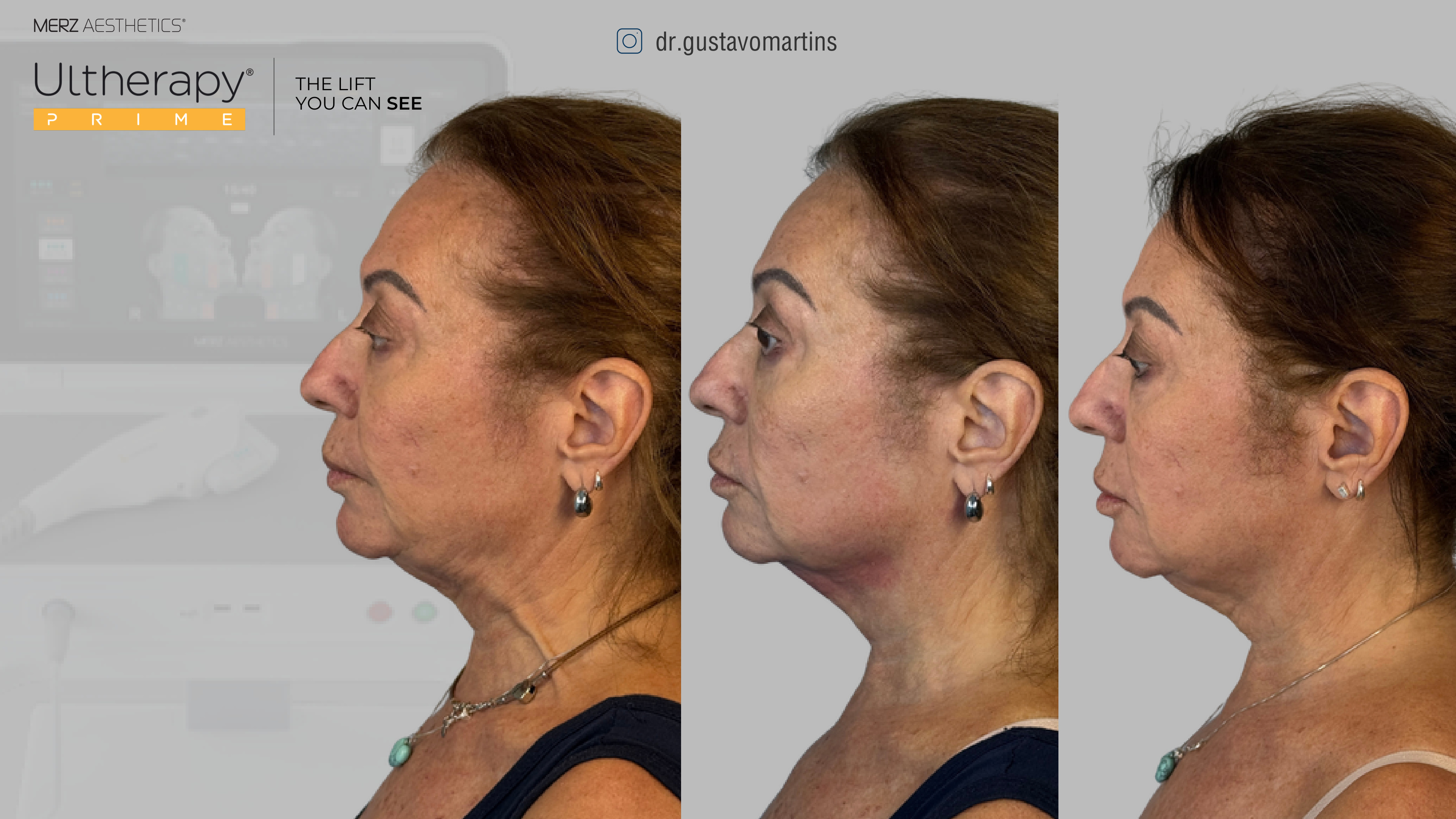 Antes e depois Ultherapy — série de resultado, vista de perfil