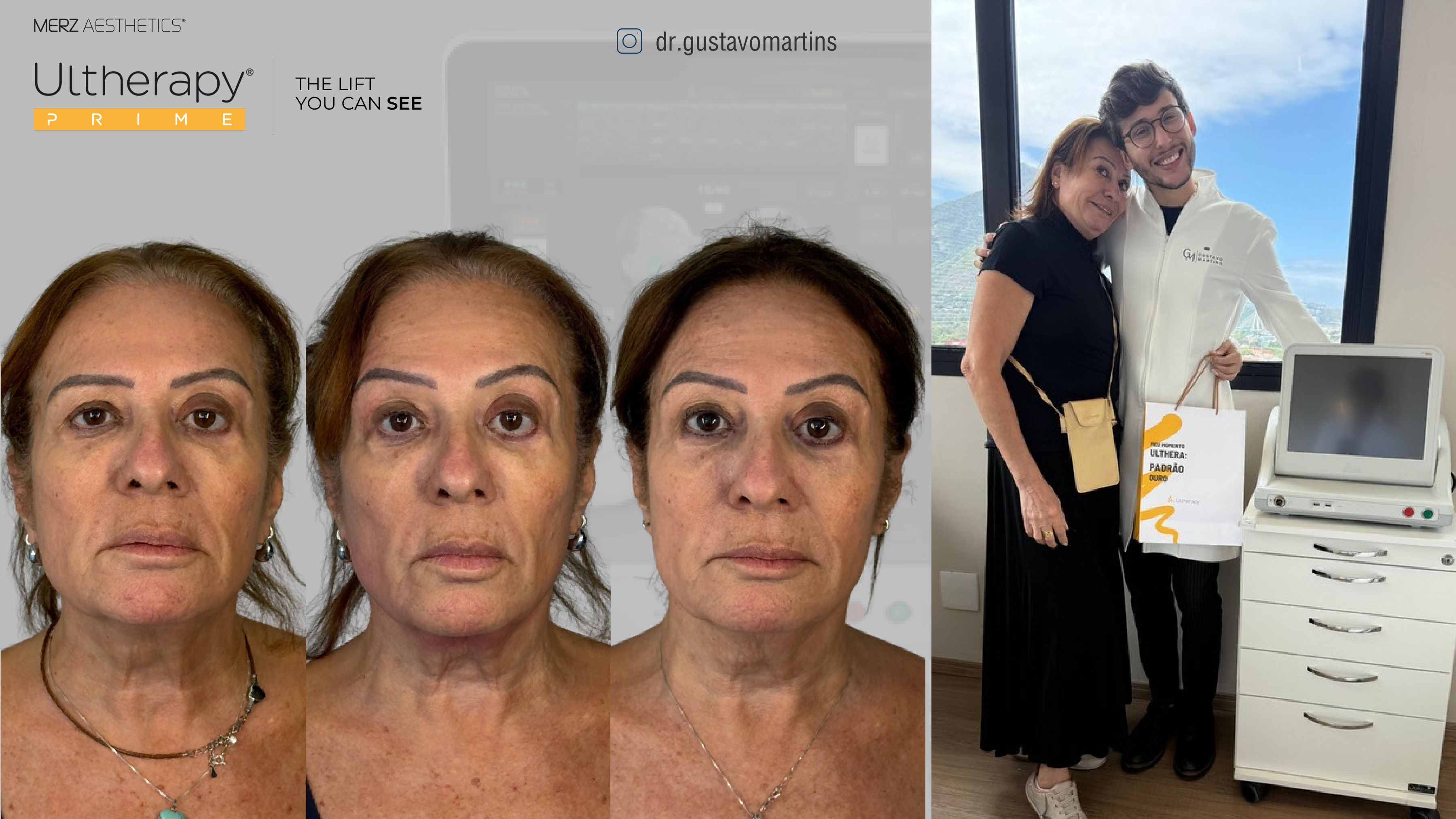 Antes e depois Ultherapy — série de resultado, vista frontal